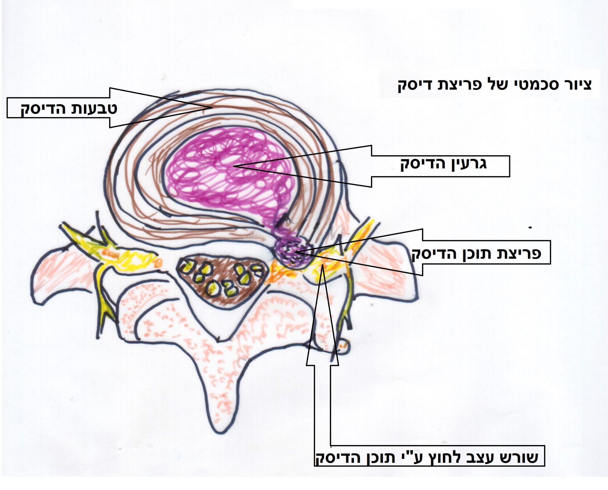 פריצת דיסק בעמוד השדרה המותני והצווארי