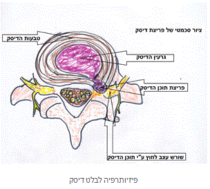 פיזיותרפיה לבלט דיסק בעמוד השדרה הצווארי