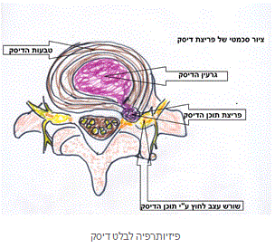 טיפול בפריצת דיסק