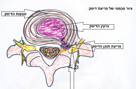 פיזיותרפיה לבלט דיסק בעמוד השדרה הצווארי