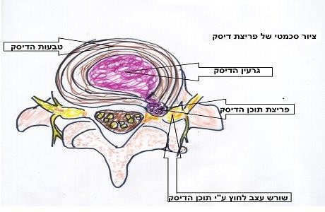 טיפול בבלט דיסק צווארי