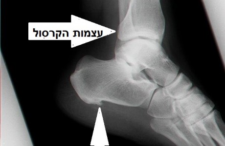 דורבן העקב (plantar fasciitis)