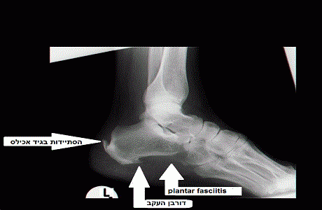 גלי הלם – טיפול בדלקת גיד אכילס