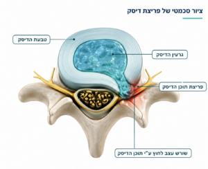 פריצת דיסק